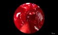 Approche Transnasale Endoscopique pour Résection de Microadénome Hypophysaire chez un Patient Atteint d'Acromégalie