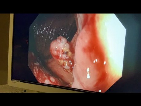 La mucosectomie endoscopique en cas du polype sessile du côlon