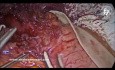 Myotomie de Heller Laparoscopique et Fundoplicature Dor