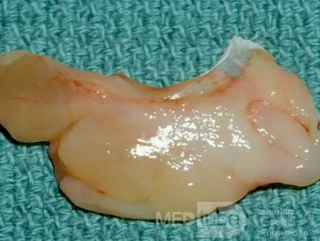 Dégénérescence polypoïde de la surface latérale de concha bullosa