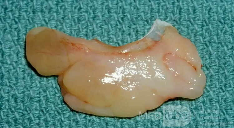 Dégénérescence polypoïde de la surface latérale de concha bullosa