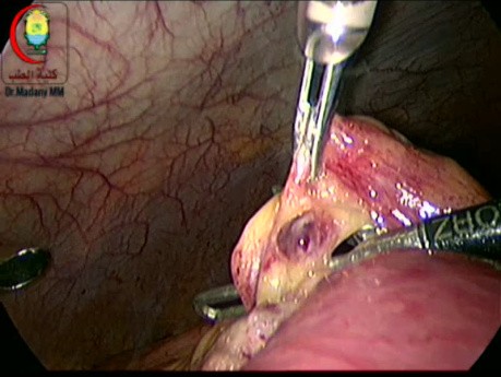 Occlusion Intestinale sur Bride