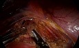 Syndrome du ligament arqué médian (syndrome de Dunbar) - Lésion du tronc cœliaque au cours du traitement laparoscopique