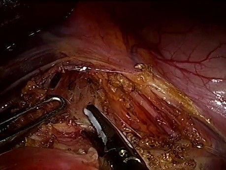 Syndrome du ligament arqué médian (syndrome de Dunbar) - Lésion du tronc cœliaque au cours du traitement laparoscopique