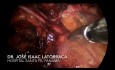 Traitement laparoscopique de hernie inguinale récidivante - technique trans-abdominale pré-péritonéale