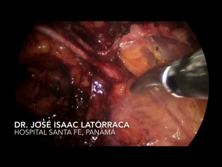 Traitement laparoscopique de hernie inguinale récidivante - technique trans-abdominale pré-péritonéale