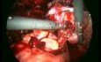 Traitement chirurgical de l'endométriose par voie cœlioscopique