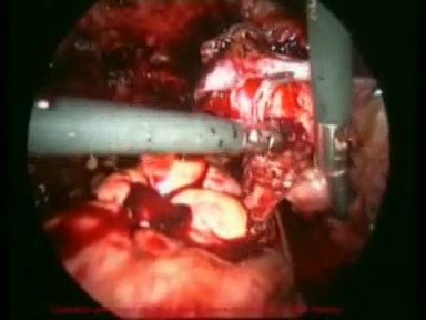Traitement chirurgical de l'endométriose par voie cœlioscopique