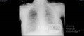 Radiographie thoracique d'un patient COVID-19 (4)