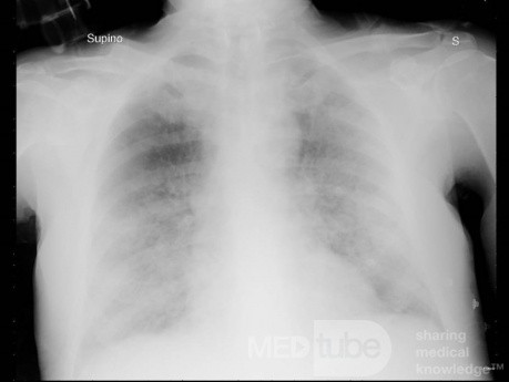 Radiographie thoracique d'un patient COVID-19 (4)