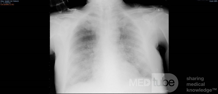 Radiographie thoracique d'un patient COVID-19 (4)