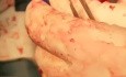 Utilisation Peropératoire d'une valve TAVI pour une Réintervention Chirurgicale sur Valve Fortement Calcifiée