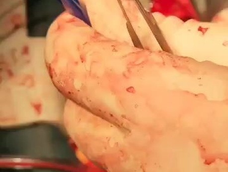 Utilisation Peropératoire d'une valve TAVI pour une Réintervention Chirurgicale sur Valve Fortement Calcifiée