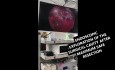 Craniotomie Frontale Minimale et Résection Tumorale Chirurgicale Maximale Sûre