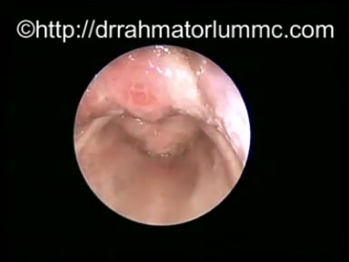 Kyste de la Vallécule Congénital - Vue Endoscopique