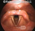 L'entrée du larynx.