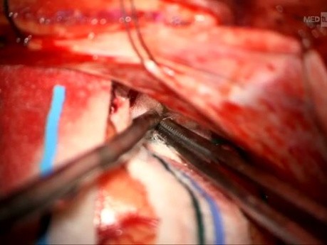 Abord Ptérional Droit pour Résection du Méningiome du Sillon Olfactif