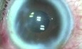 Cataracte - ablation par plasma