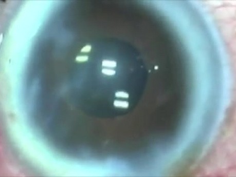 Cataracte - ablation par plasma