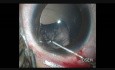 Ectopie cristalline - Implantation de lentille intraoculaire