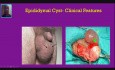 Tuméfaction scrotale - Cas n° 3 - Kyste de l'épididyme