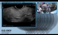 Thermoablation (RFA) sous contrôle par l'échographie endoscopiques (EUS) avec un produit de contraste (SonoVue)