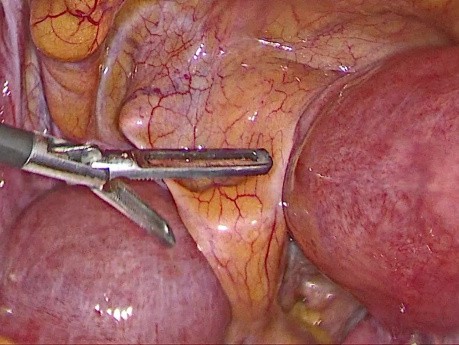 Hystérectomie Laparoscopique Totale pour Utérus Bicorne 