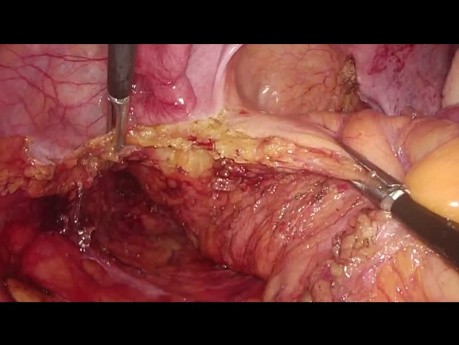 Résection intersphinctérienne laparoscopique pour cancer intra-anal - procédure complète