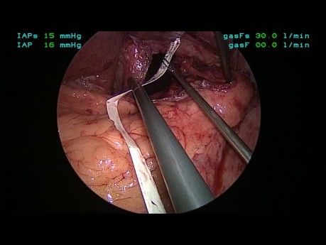 Application - Tutoriel Fundoplicature Géométrie, Chapitre 05 - Fermeture du hiatus œsophagien