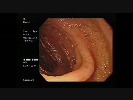 Le lymphome T périphérique sans autre précision (PTCL NOS) de l'intestin grêle