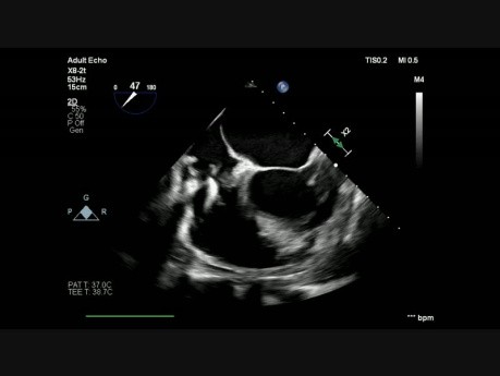 Endocardite infectieuse liée au dispositif intracardiaque