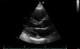 L'échocardiographie 3D en temps réel - vue à long axe parasternal de la valve mitrale (VM) ,  vidéo n ° 1