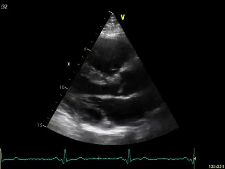 L'échocardiographie 3D en temps réel - vue à long axe parasternal de la valve mitrale (VM) ,  vidéo n ° 1