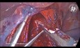 Sauver la Branche Hépatique du Nerf Vague Antérieur dans la Myotomie de Heller et la Fundoplicature Dor pour l'Achalasie
