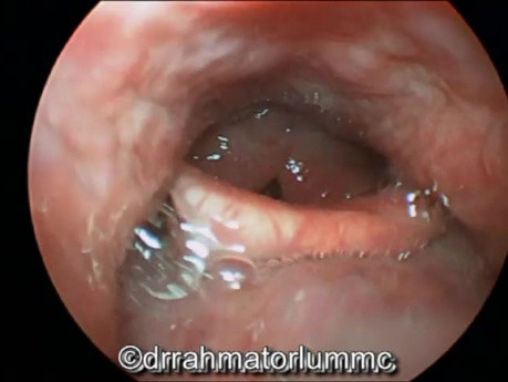 Aspect Endoscopique Laryngé Typique de la Laryngite par Reflux