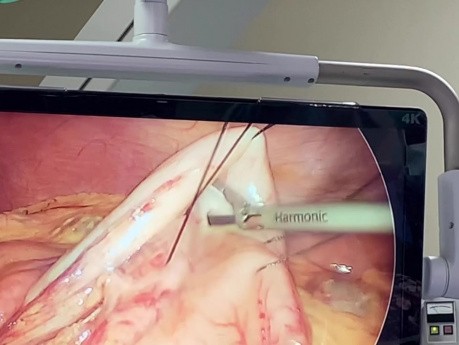 CPRE assistée par laparoscopie lors du bypass gastrique