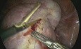 Excision bilatérale de kyste dermoïde de grande taille avec préservation des deux ovaires réalisée par laparoscopie