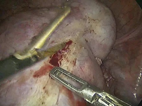 Excision bilatérale de kyste dermoïde de grande taille avec préservation des deux ovaires réalisée par laparoscopie