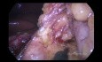 Gastrectomie polaire supérieure avec rétablissement de la continuité à double voie (double tract) par cœlioscopie