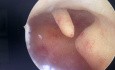Polype Endométrial en Hystéroscopie
