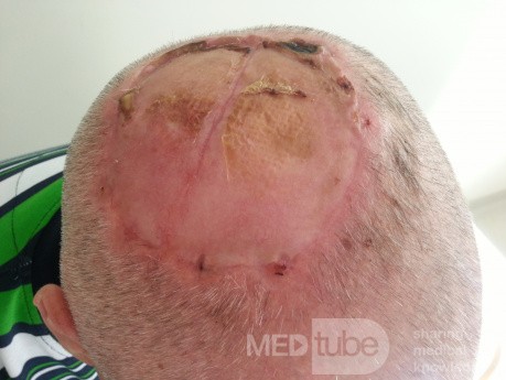 Angiosarcome du cuir chevelu - Excision et lambeau cutané libre prélevés de deux bras de la face médiale