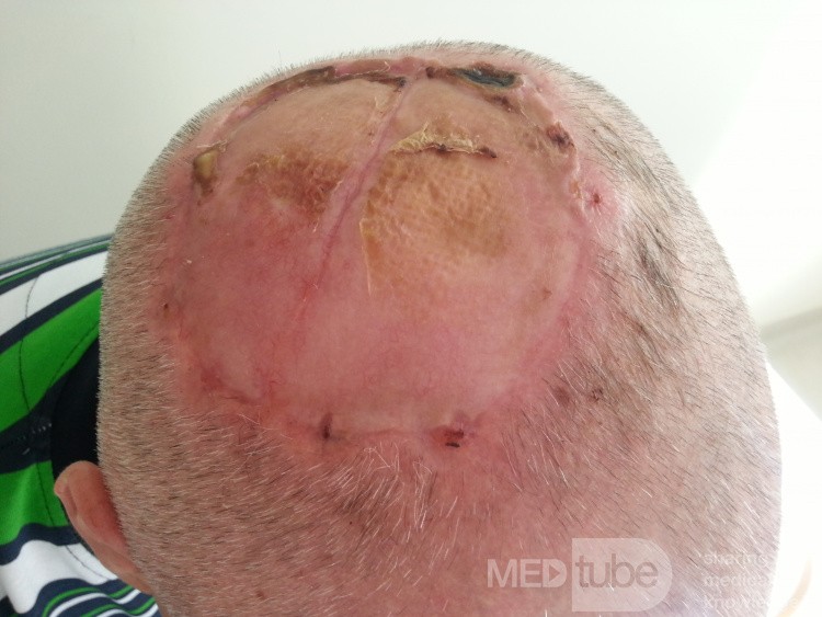 Angiosarcome du cuir chevelu - Excision et lambeau cutané libre prélevés de deux bras de la face médiale