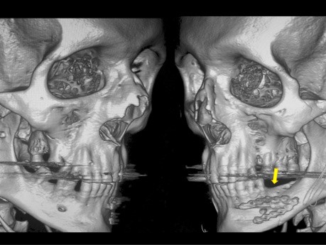 Fonction de l'ATM après Ostéosynthèse d'une Fracture du Condyle Mandibulaire