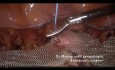 Une pectopexie laparoscopique pour prolapsus génito - urinaire .