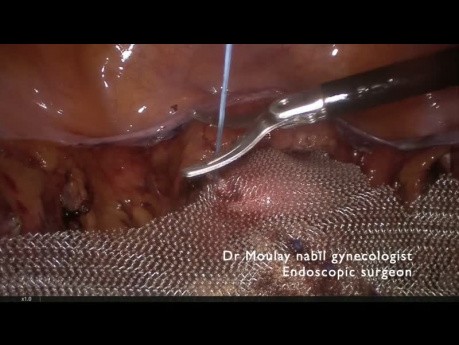 Une pectopexie laparoscopique pour prolapsus génito - urinaire .