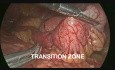 Occlusion de l'intestin grêle sur un corps étranger - prise en charge laparoscopique