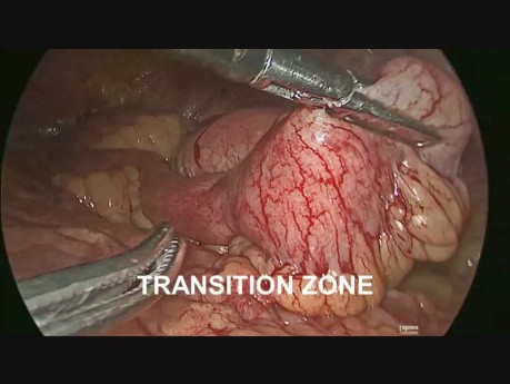 Occlusion de l'intestin grêle sur un corps étranger - prise en charge laparoscopique