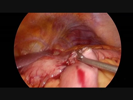 Gastro-entéroanastomose intracorporelle laparoscopique faite à la main et anastomose brune dans le cancer gastrique distal avancé