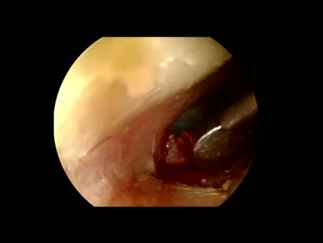 Élévation Endoscopique du Lambeau Tympano-Méatal