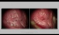 Traitement du condylome de la vulve NIV 2